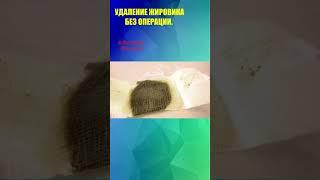 УДАЛЕНИЕ ЖИРОВИКА БЕЗ ОПЕРАЦИИ.#shorts