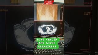 LUNG CANCER AND LIVER METASTASIS #chest #ctscan #cancer #metastasis #liver