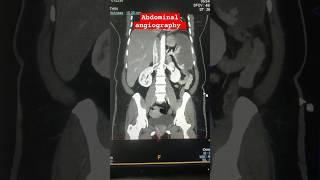 abdominal angiography #shorts #biology #doctor #shortsfeed @hemantkushwah3453