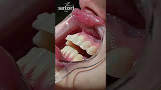 Элайнеры для исправления прикуса  #dentist #стоматология #braces