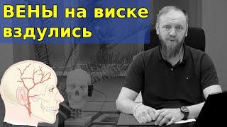  Вена на виске вздулась и пульсирует (причина и как убрать)