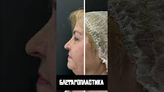 Это наша пациентка после блефаропластики верхних век #пластикавек #хирург #москва #калининград39