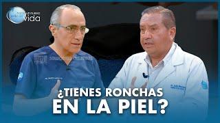 ¿TIENES RONCHAS EN LA PIEL? 