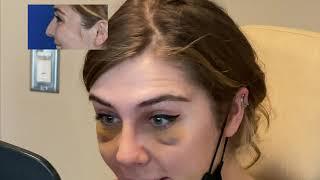 Rhinoplasty in Seattle WA | Rhinoplasty Reveal | Before and After