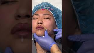 Lip Filler #filler #lipfillers #lipfiller #lipfillerinjections #medspa