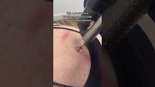 Laser Scar Removal