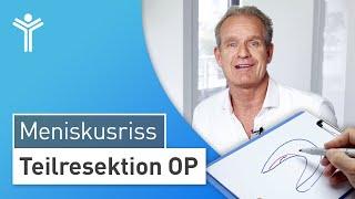 Meniskus OP: Meniskusriss arthroskopisch behandeln | Teilresektion