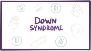 Down syndrome (trisomy 21) - causes, symptoms, diagnosis, & pathology