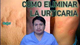 COMO ELIMINAR LA URTICARIA - RONCHAS