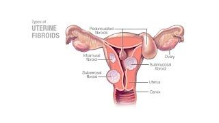 Mayo Clinic Minute - Can uterine fibroids affect pregnancy?