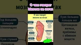 О чем говорят мазоли на ногах #натоптыши #мозоль #мозолинаногах  #здоровье