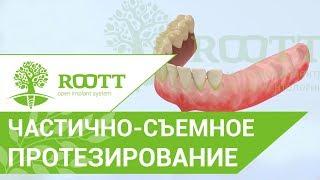 Частично - съемное протезирование после удаления зуба. Частично съемное протезирование. ROOTT.