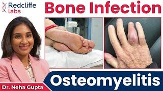  What is Osteomyelitis? Osteomyelitis (Bone Infection) Symptoms, Causes And Treatment | Redcliffe