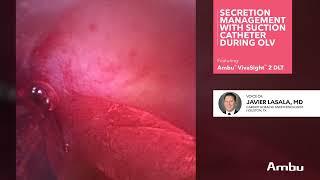 Secretion Management with Suction Catheter During OLV | Dr.  Lasala Using the VivaSight 2 DLT