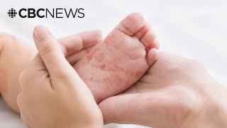 What we know about the Ontario measles death