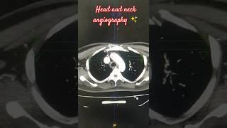 head and neck angiography #ctscan #radiology #head #neck #angiogram @hemantkushwah3453