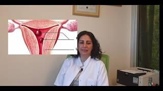 Endometrial polip nedir - Endometrial polip tedavisi