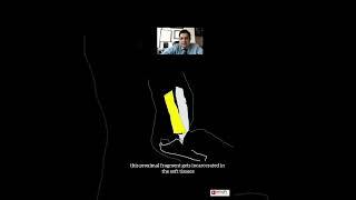 Watch for Pucker Sign - Dr. Rajeev Nirwane