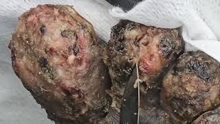 Philip Butabila -  jiggers, dead skin #2 ---long videos @riseupsociety.net & @ruskenya.org
