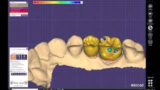 EXOCAD №6 Plovdiv  Full Anatomy 25-26 dent /Exocad повна анатомія 25-26 зуба / EXOCAD 2022 /