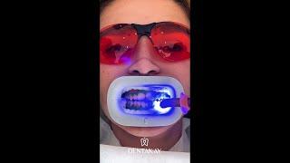 Amazing Teeth whitening