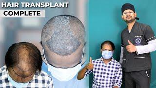 Hair Transplant in Bhopal | Cost of Hair Transplant in Bhopal | Hair Transplant Doctor in Bhopal