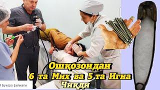 Шок хабар. Ёш йигитни ошқозонидан 6 та мих, 5 та Туғноғич чиқди