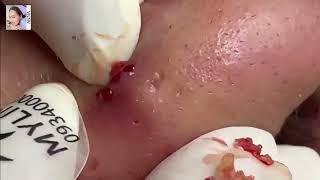 Super Hard Nose Blackheads removal Satisfying !   Anna Facial Treatment   007