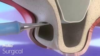 Dental Implants | Sinus Lift & Bone Graft