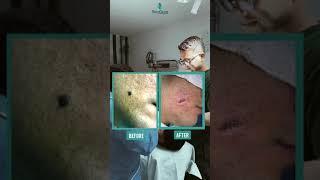  Mole removal by surgery  #shorts #mole