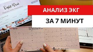 Научись анализировать ЭКГ за 7 минут!!! (Подробный разбор ЭКГ).