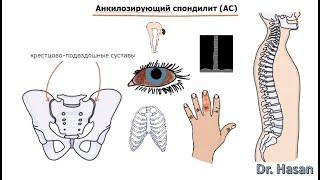 Анкилозирующий спондилит (болезнь Бехтерева) | определение, этиология, патогенез, клиника, диаг, леч