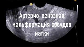 Артерио-венозная мальформация сосудов матки