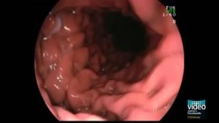 Diagnosis and Grading of Sliding Hiatal Hernia