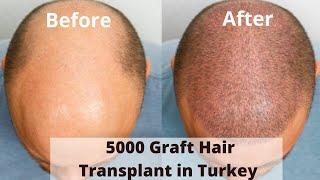 5000 Graft Hair Transplant in Turkey | 5000 Grafts Hair Transplant Cost in Turkey