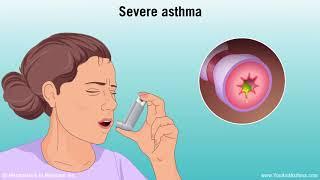 Understanding Asthma: Mild, Moderate, and Severe