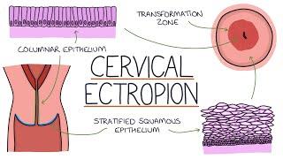 Understanding Cervical Ectropion / Cervical Erosion