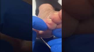 Podiatrist's Guide: Pain-Free Foot Corn Removal #FootCare #PodiatryTips