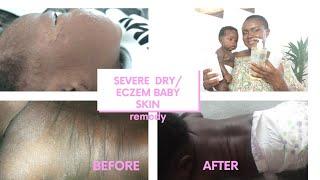 TREAT SEVERE DRY AND ECZEMA SKIN ON BABIES/TODDLERS