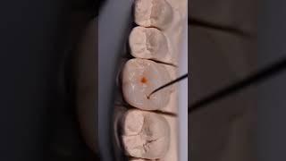 Dental motivation. Direct composite restoration lateral group teeth. #dental #dentalcourses
