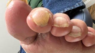 CURLY YELLOW NAIL - DR. BINH IS BACK!