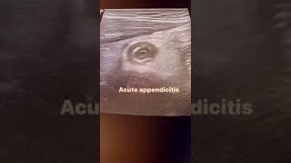 Acute appendicites#learning #ultrasound #imaging #medicine #viral