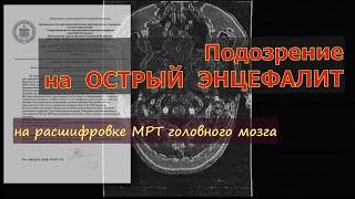 ДЕМИЕЛИНИЗИРУЮЩИЙ процесс с подозрением на ОСТРЫЙ ЭНЦЕФАЛИТ на РАСШИФРОВКЕ МРТ головного мозга