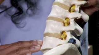 Lumbar Spondylosis
