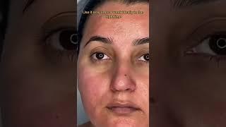 acne scars removal using pilgrim chemical peeling solution | peeling treatment on face #shorts