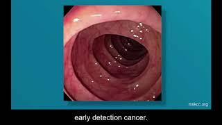 Colonoscopy & Other Screening Tests for Colorectal Cancer