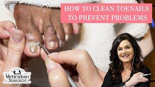 How to Remove Corn on Toe and Pedicure Toenail Cleaning