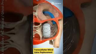 Altavalve: Transcatheter Mitral Valve Replacement (TMVR) #shorts #medical #animation