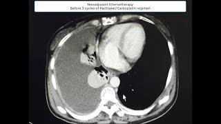 NEOADJUVANT CHEMOTHERAPY FOR EOC WITH GOOD RESPONSE