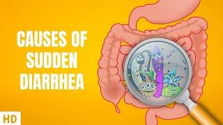 Causes of Sudden Diarrhea